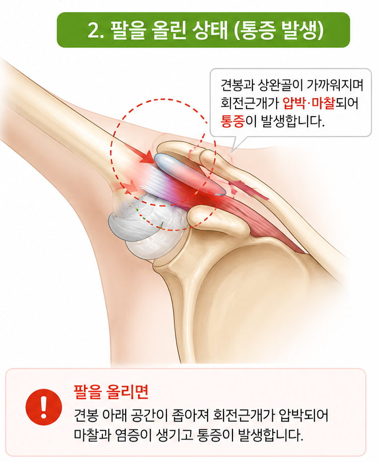 대구 어깨통증 원인 회전근개 통증