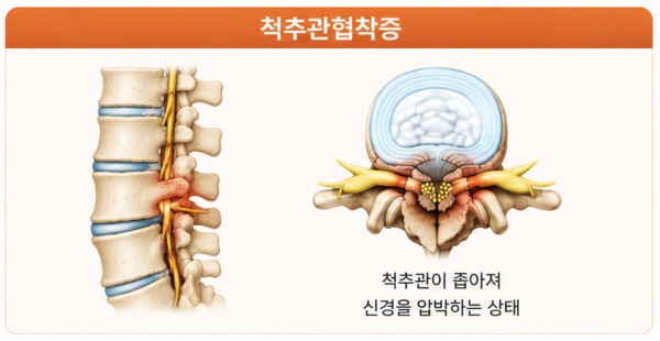 척추관협착증