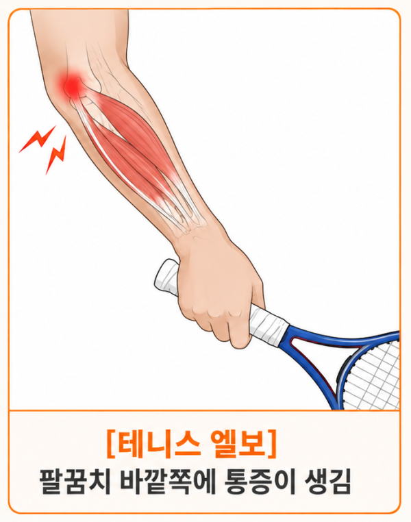 대구 테니스 엘보