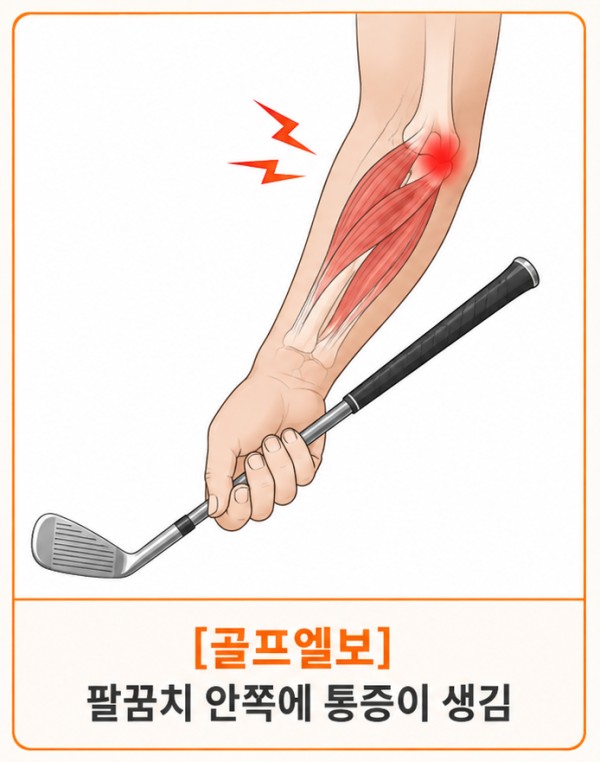 대구 골프 엘보